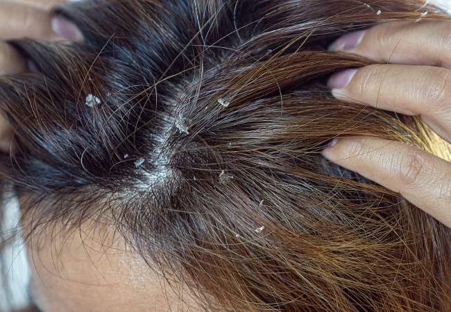 Tratamentos Sistêmicos para Psoríase Grave: Opções e Efeitos Colaterais