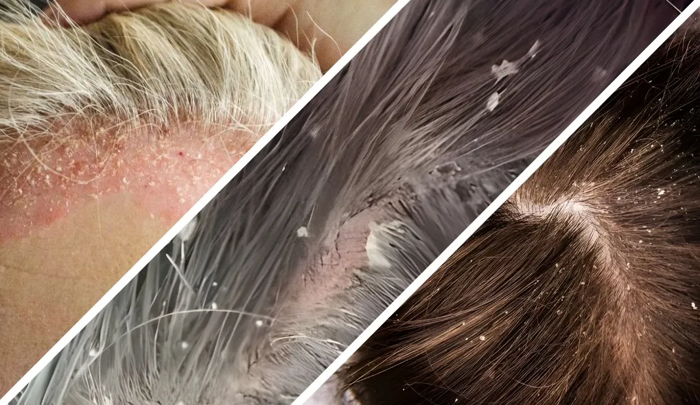 Psoríase vs. Dermatite Seborreica: Entenda as Diferenças e Saiba Identificar