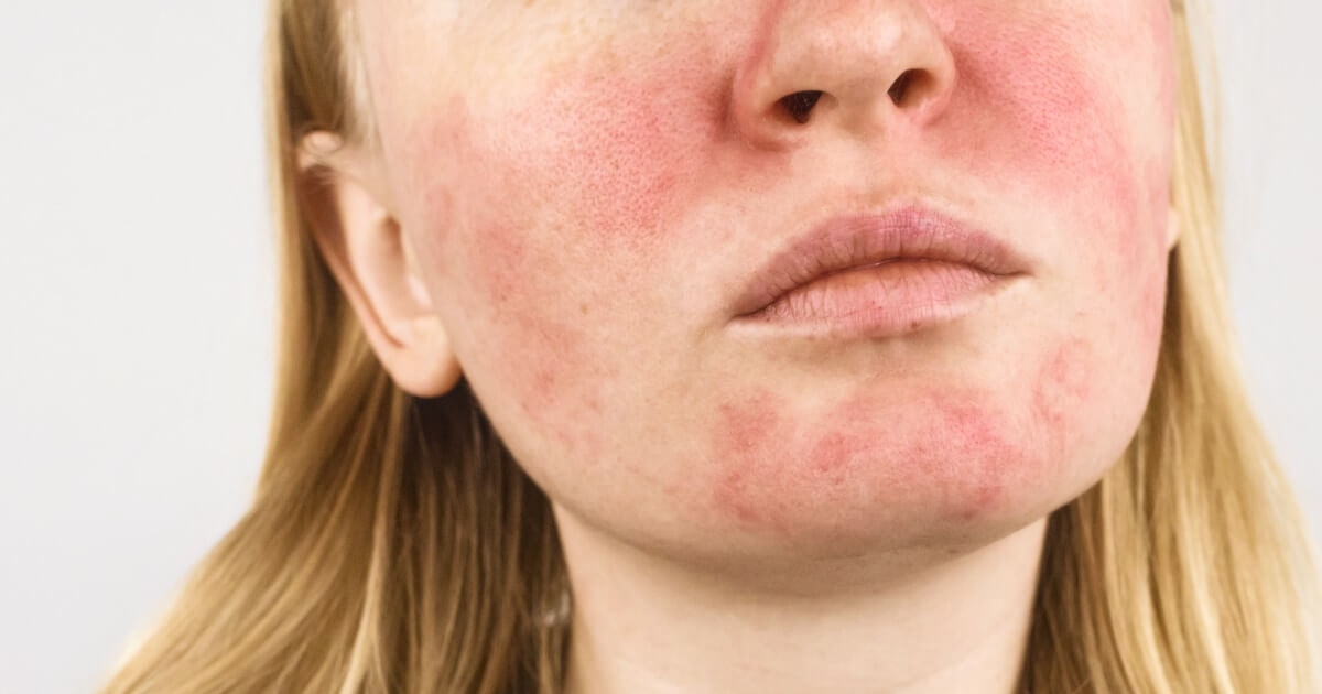 Alimentação e Rosácea: O Que Comer e o Que Evitar