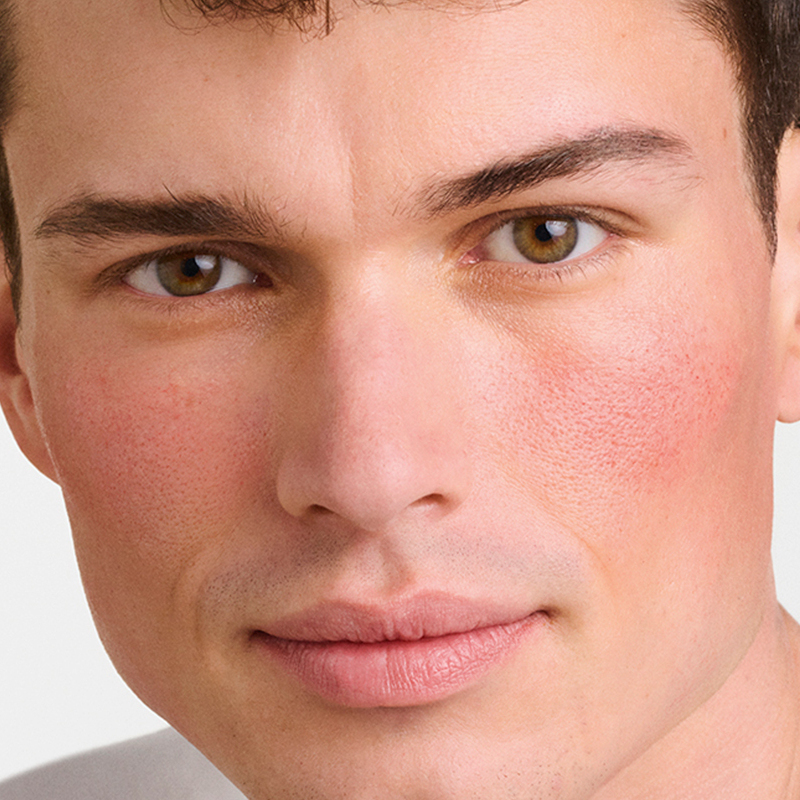 Medicamentos para Rosácea: Opções Tópicas e Orais