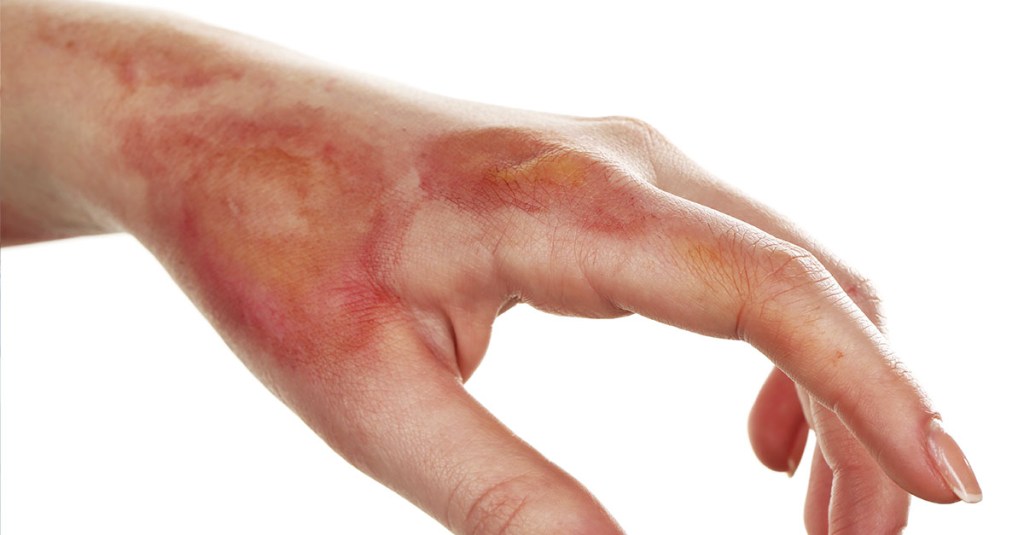 1. Como identificar o grau de uma queimadura?
2. Cuidados com queimaduras em crianças: o que fazer?
3. Tratamento de queimaduras químicas: passo a passo.
4. Produtos recomendados para recuperação de queimaduras leves.
5. Quando a queimadura exige atendimento médico de emergência?