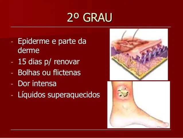 1. Como identificar o grau de uma queimadura?
2. Cuidados com queimaduras em crianças: o que fazer?
3. Tratamento de queimaduras químicas: passo a passo.
4. Produtos recomendados para recuperação de queimaduras leves.
5. Quando a queimadura exige atendimento médico de emergência?